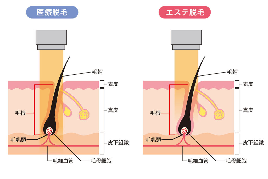 医療レーザー脱毛とエステ脱毛との違い