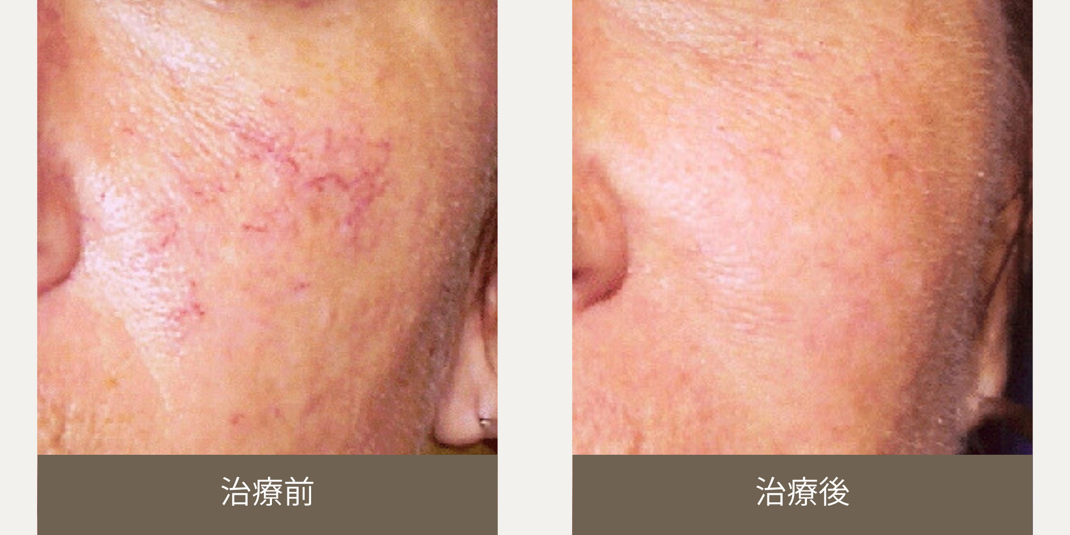 毛細血管拡張症治療前・後